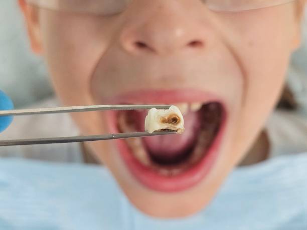 Best Emergency Dentist for Knocked-Out Tooth in Lewistown, IL
